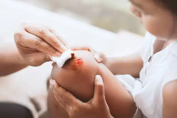 Los raspones son de las heridas más comunes